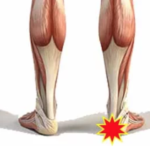 Achilles Tendonopathy - Ankle pain