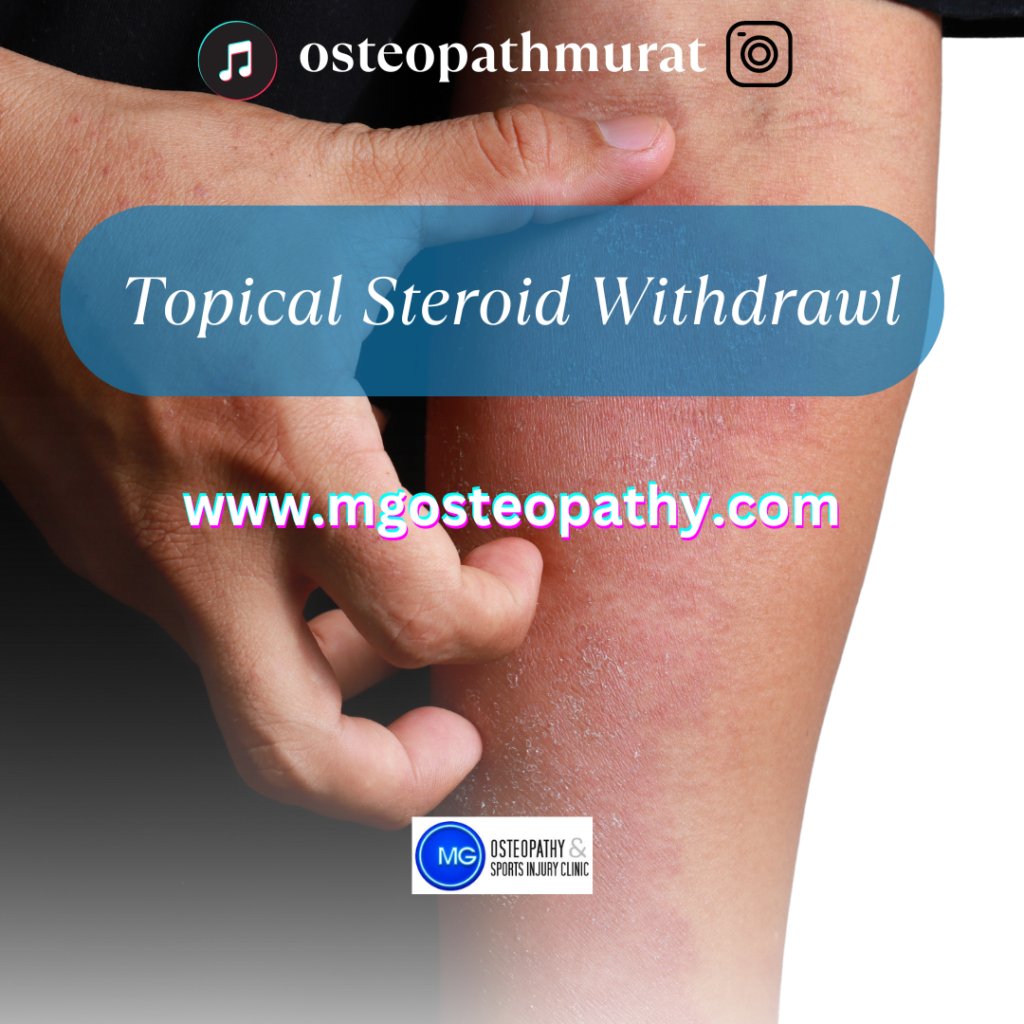 Topical-Steroid-Withdrawl-MG-Osteopathy