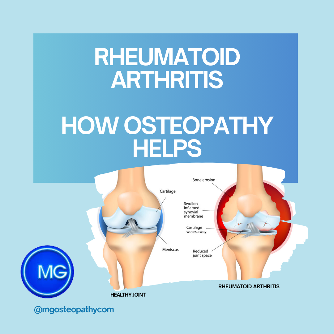 Rheumatoid Arthritis | MG Osteopathy & Sports Injury Clinic, Hackney, London | MG Osteopathy & Sports Injury Clinic, Hackney, London